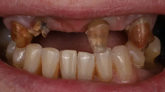Full Mouth Reconstruction — before treatment by Dr. Jay Siddiqui at Radiant Dental Care Chevy Chase