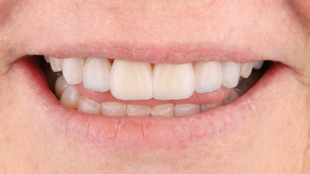 Smile Makeover — after treatment by Dr. Jay Siddiqui at Radiant Dental Care Chevy Chase