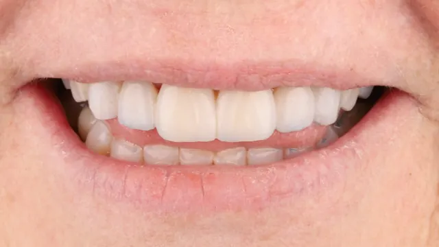 Smile Makeover — after treatment by Dr. Jay Siddiqui at Radiant Dental Care Chevy Chase