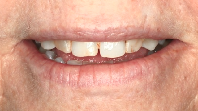 Smile Makeover — before treatment by Dr. Jay Siddiqui at Radiant Dental Care Chevy Chase