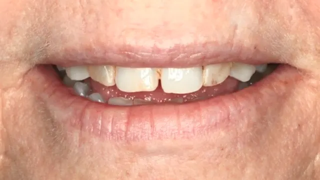 Smile Makeover — before treatment by Dr. Jay Siddiqui at Radiant Dental Care Chevy Chase