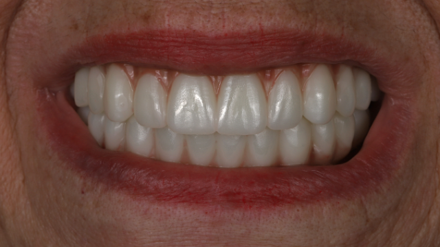 Smile Transformation — after treatment by Dr. Jay Siddiqui at Radiant Dental Care Chevy Chase