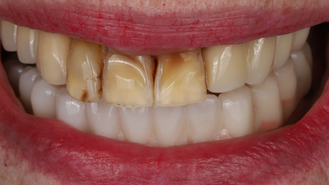 Smile Transformation — before treatment by Dr. Jay Siddiqui at Radiant Dental Care Chevy Chase