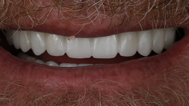 Full Arch Restoration — after treatment by Dr. Jay Siddiqui at Radiant Dental Care Chevy Chase