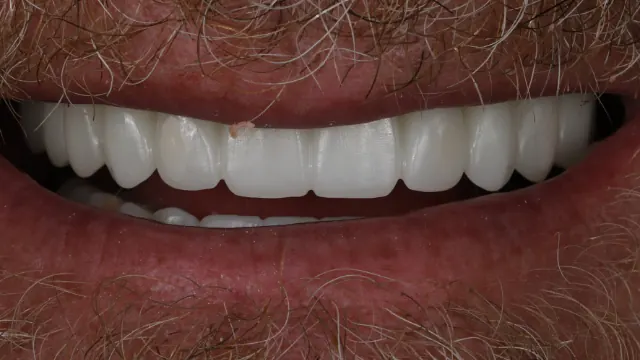 Full Arch Restoration — after treatment by Dr. Jay Siddiqui at Radiant Dental Care Chevy Chase