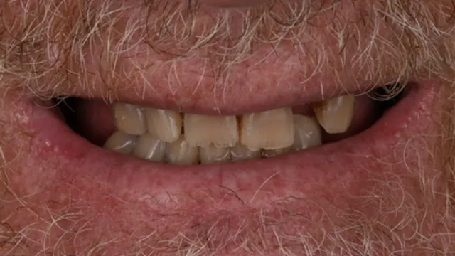 Full Arch Restoration — before treatment by Dr. Jay Siddiqui at Radiant Dental Care Chevy Chase
