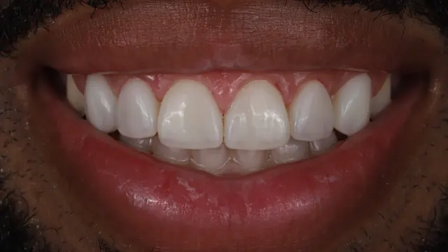 Porcelain Veneers — after treatment by Dr. Jay Siddiqui at Radiant Dental Care Chevy Chase