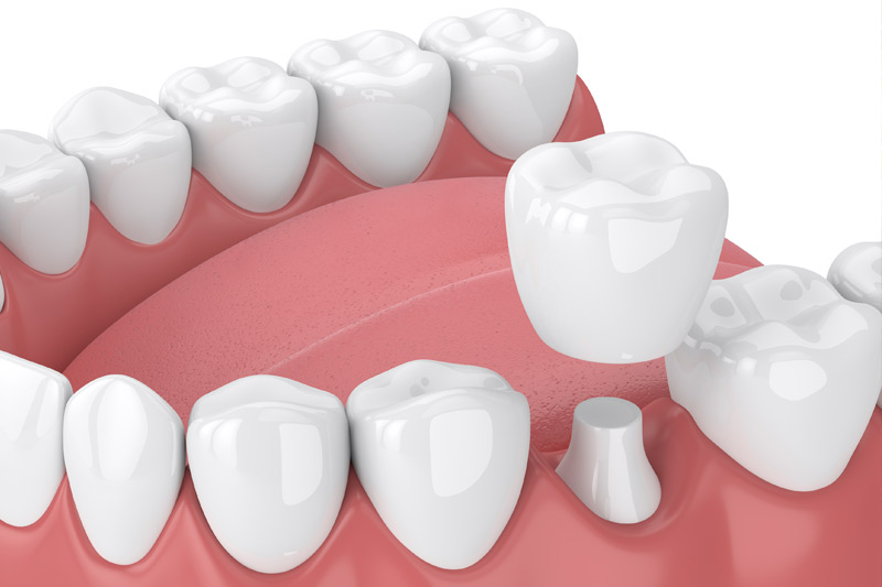 Dental Crowns in Chevy Chase