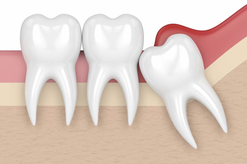 Wisdom Tooth Removal in Chevy Chase