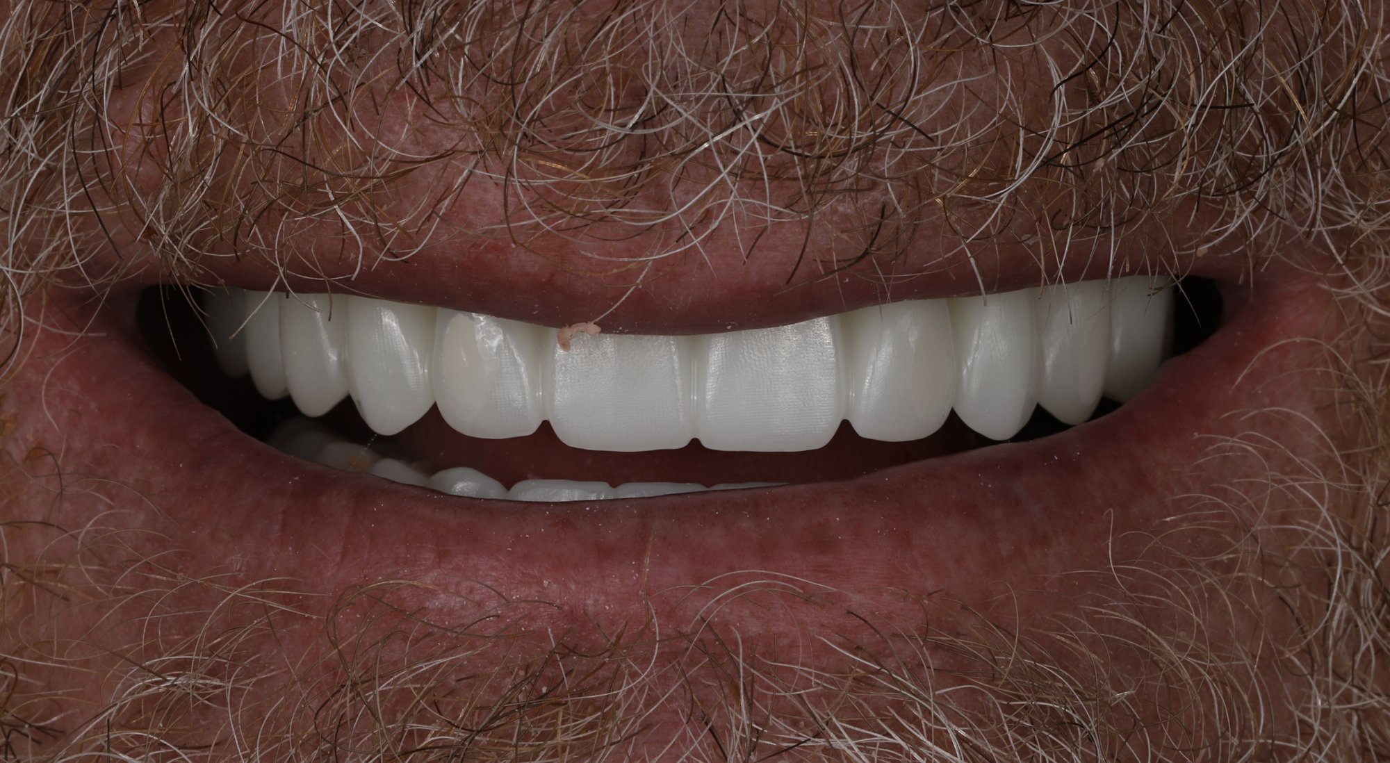 Full-arch implant case — after: fixed implant-supported upper bridge