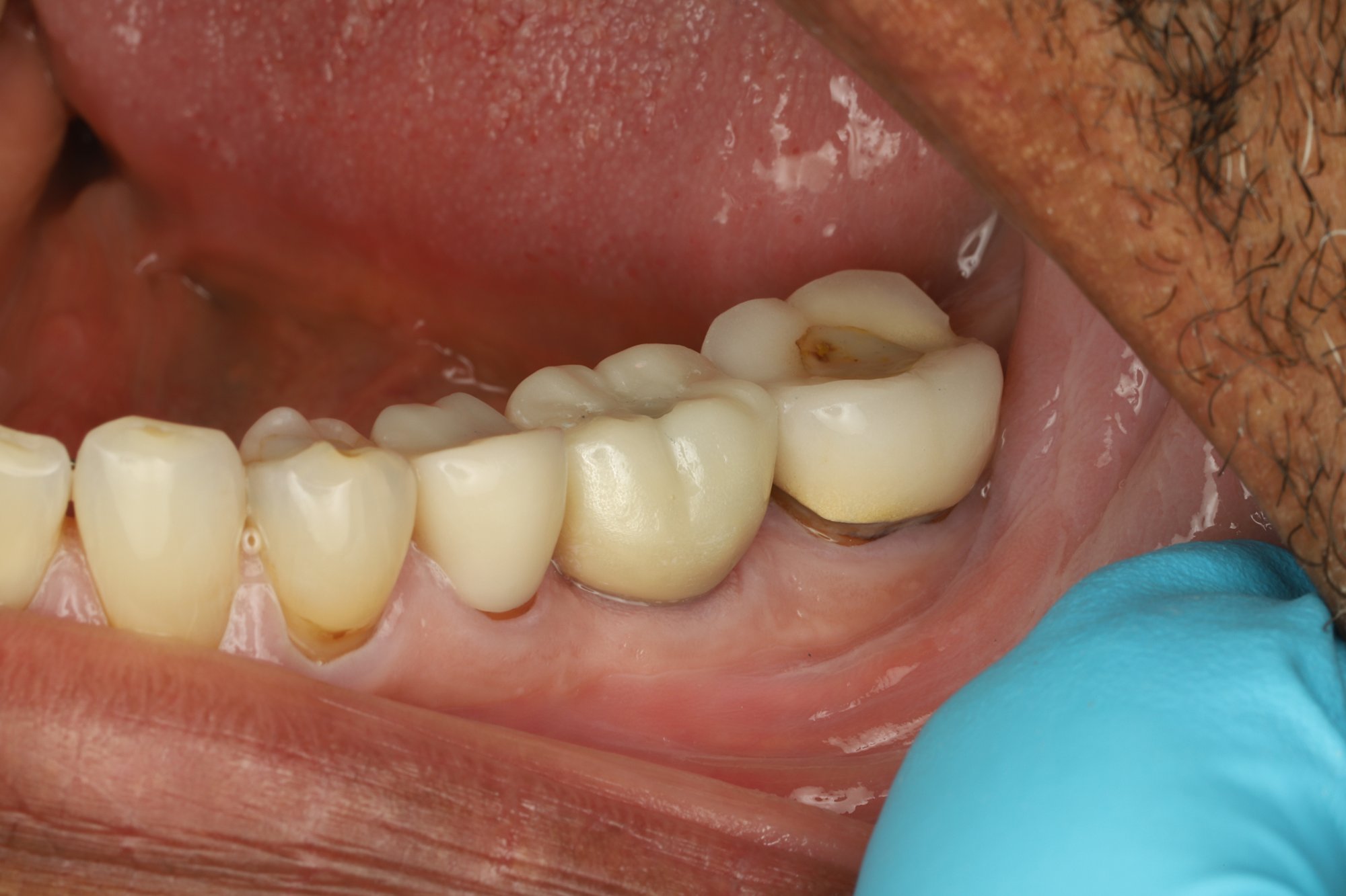 Single-tooth implant — after: fully restored implant crown in the lower arch