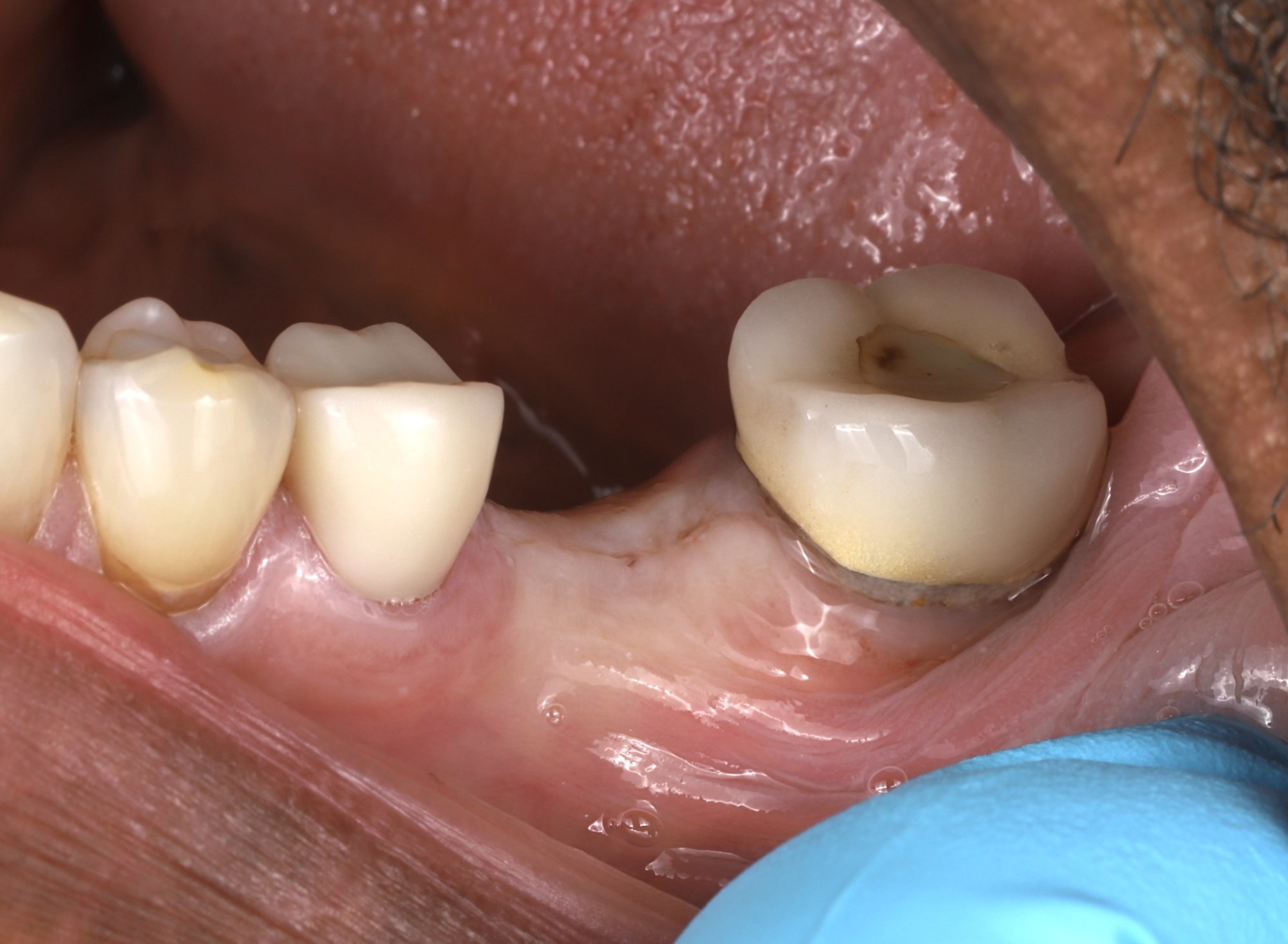 Single-tooth implant — before: failing molar with broken post-and-core restoration