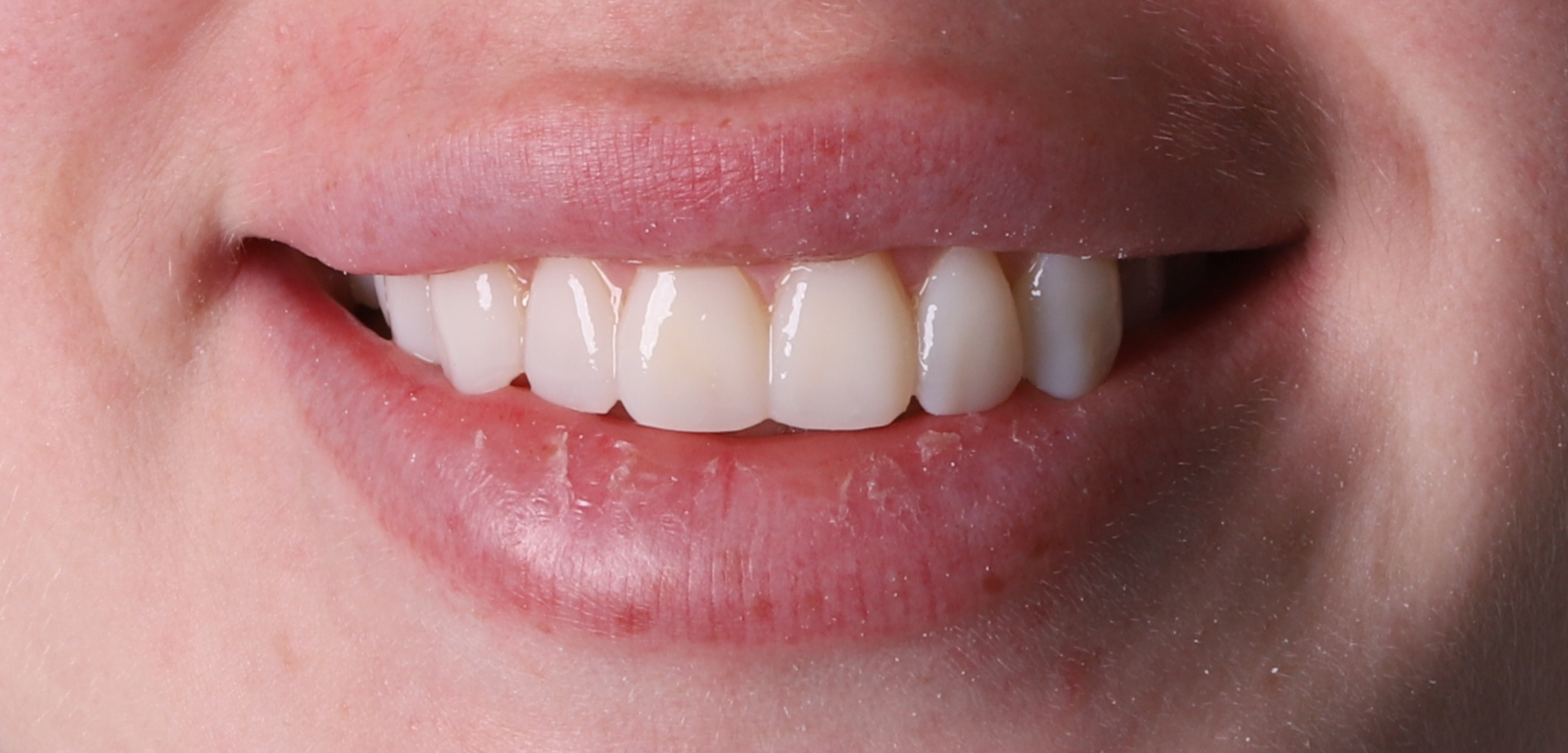 The same patient smiling after veneer treatment
