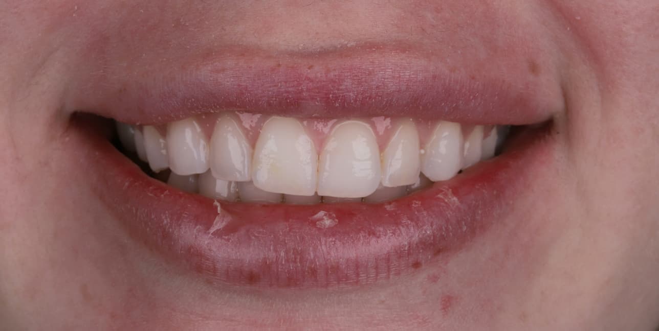 Patient smile before veneer treatment
