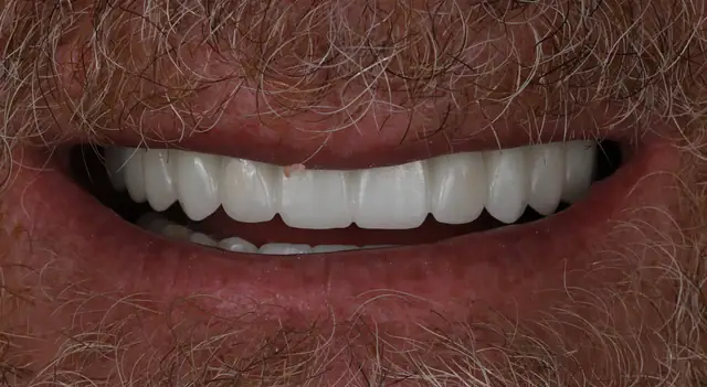 After full arch implant treatment