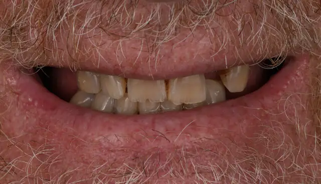 Before full arch implant treatment