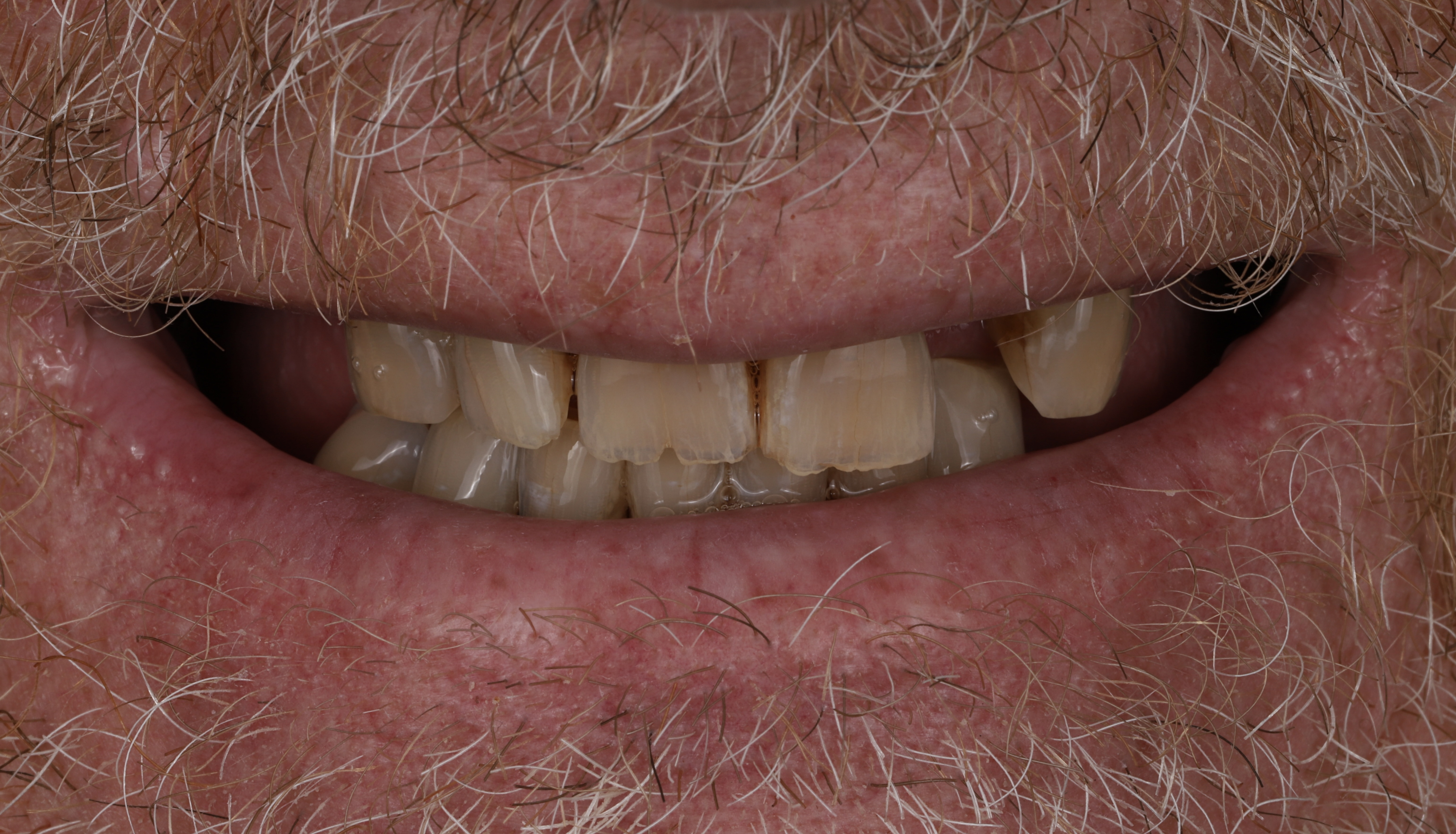 Case 01 before full arch implant treatment