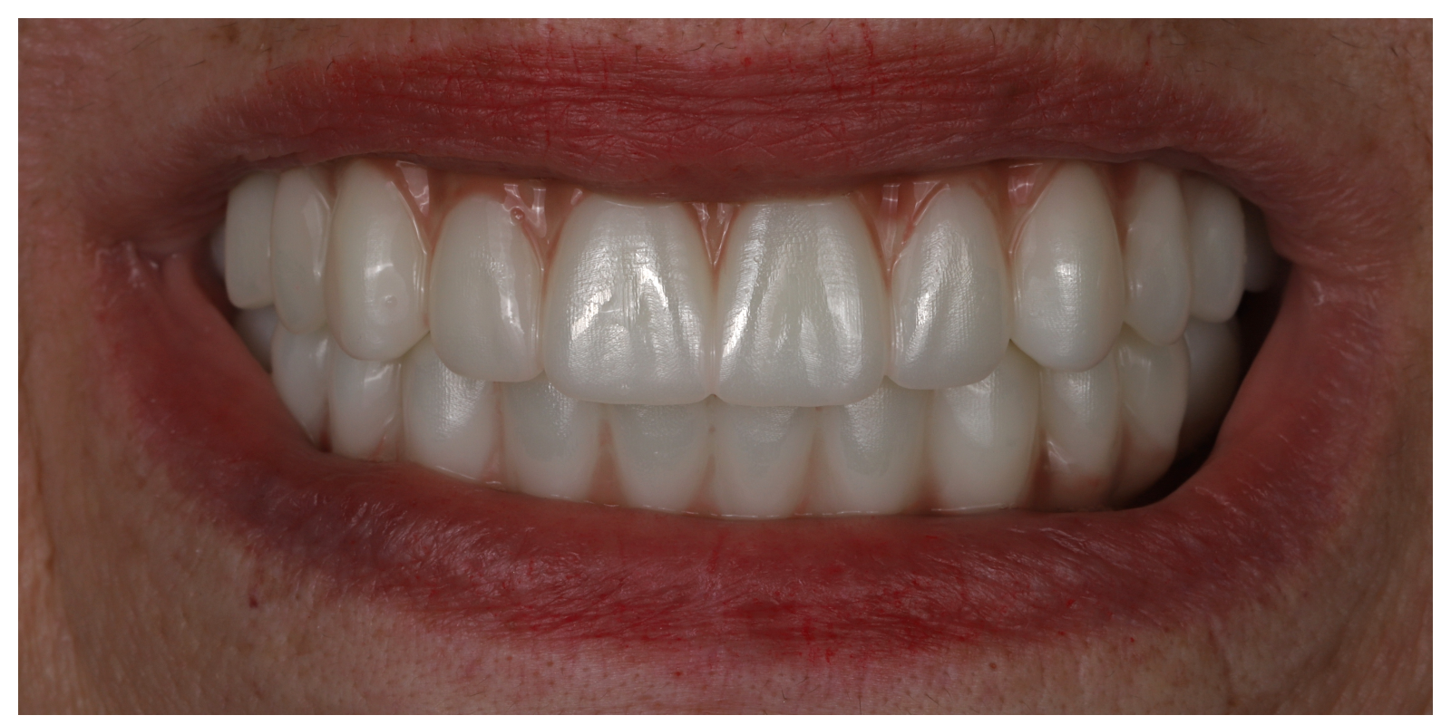 Case 02 after full arch implant treatment