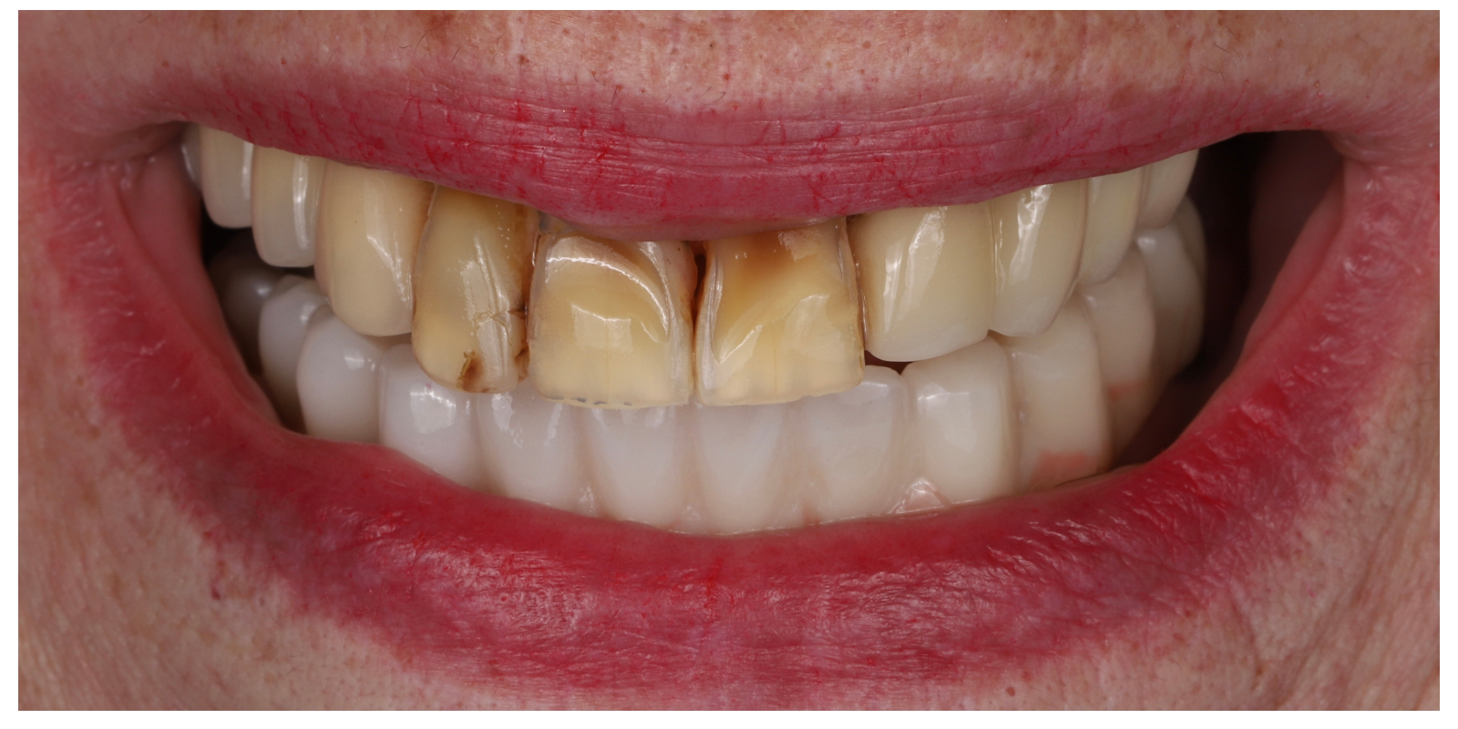 Case 02 before full arch implant treatment