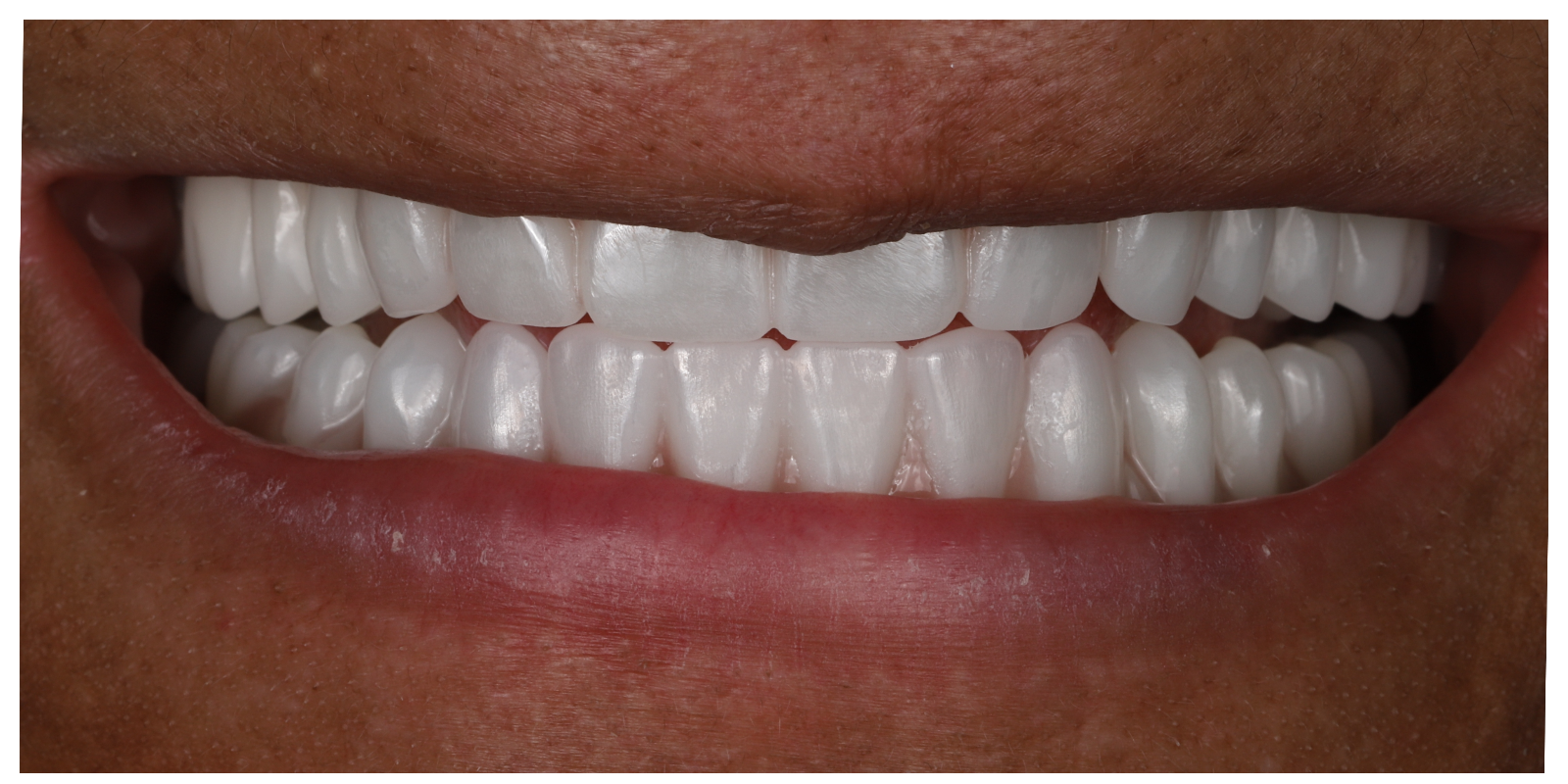 Case 03 after full arch implant treatment