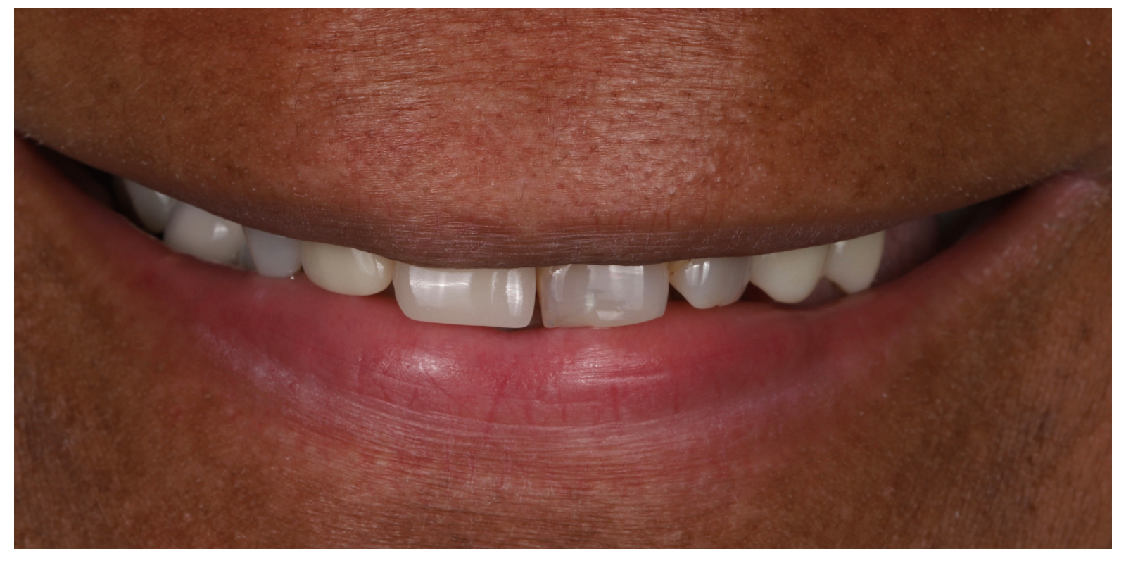 Case 03 before full arch implant treatment