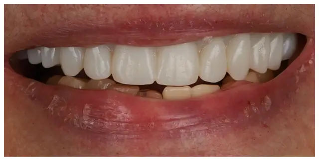 After advanced tooth loss treatment