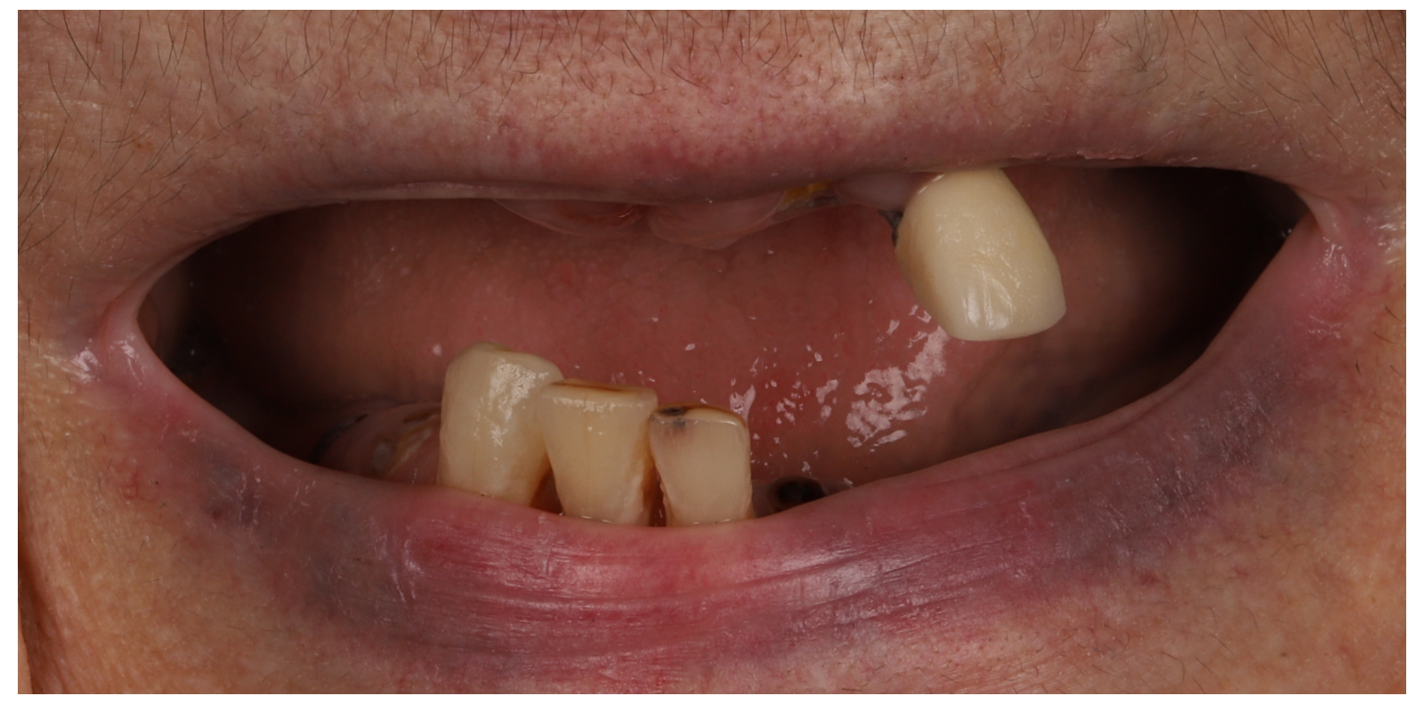 Case 04 before full arch implant treatment